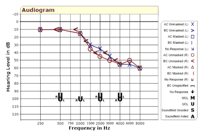 Audiogram showing results at different levels of frequency and dB